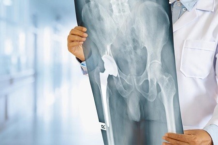 total hip replacement surgery hospital in Nagpur