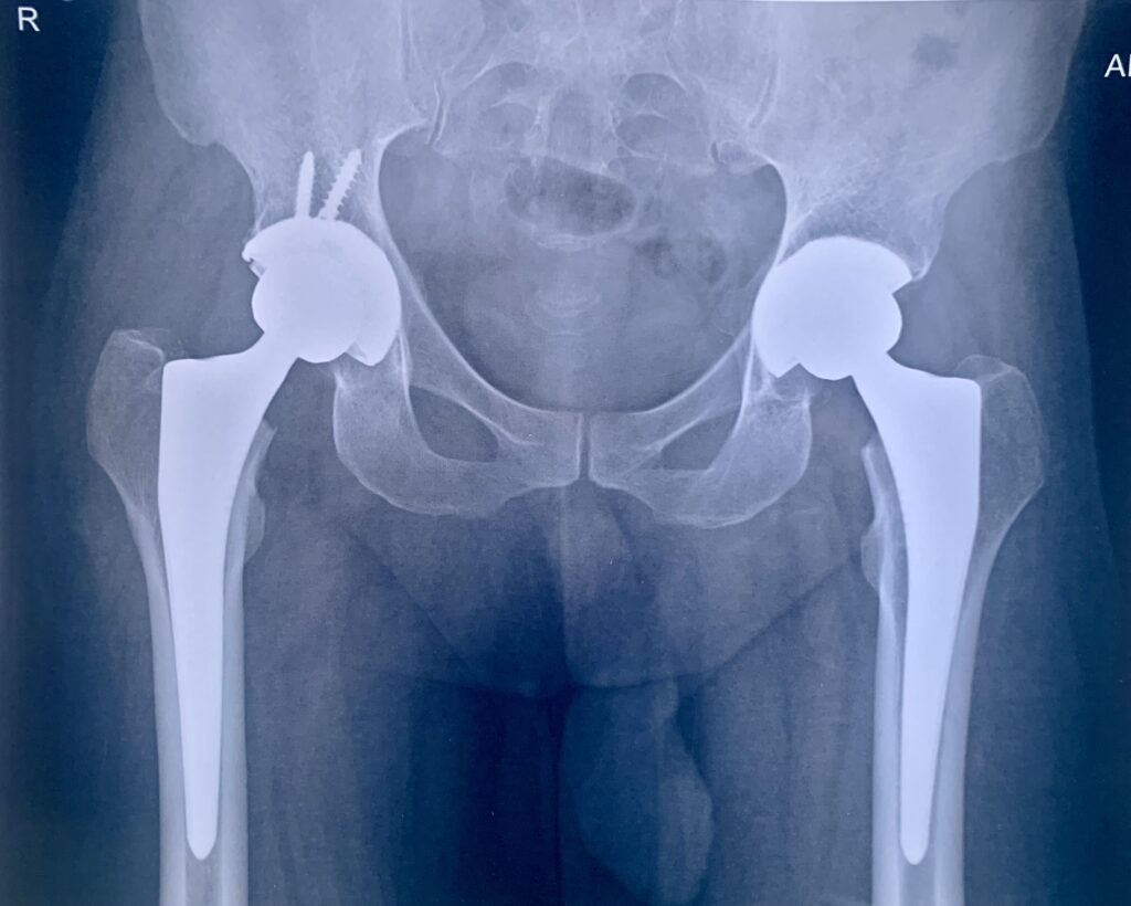 Both Hip Replacement