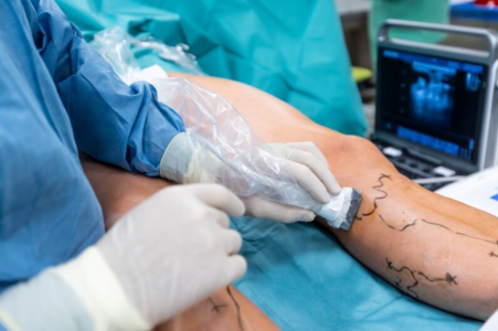 Varicose Veins Laser Surgery