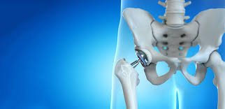 CGHS hip replacement Nagpur