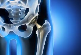 Precision hip replacement