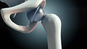 Precision hip replacement