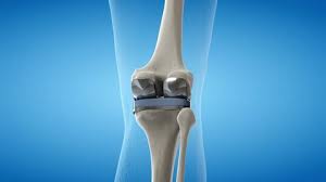 PMJAY hospital list Nagpur for joint replacement
