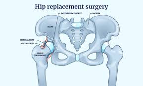 CGHS hip replacement Satna
