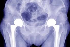 CGHS hip replacement in Rewa