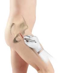 Minimally invasive hip surgery Satna