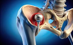 Precision Hip Replacement In Hoshangabad