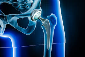 Quick recovery hip surgery in Rewa