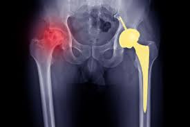 AVN treatment Gadchiroli