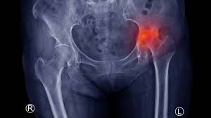 AVN treatment Gadchiroli