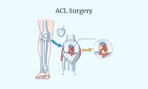 Acl Ligament Surgery in Bhandara