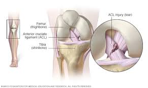 Acl Ligament Surgery in Chandrapur