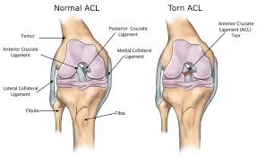 Acl Ligament Surgery in Katni