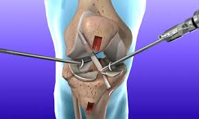 Acl Ligament Surgery in Rewa