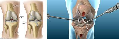 Acl ligament treatment Gondia