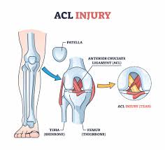 Acl ligament treatment Harda