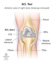 Acl ligament treatment Hoshangabad