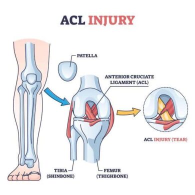 Acl ligament treatment Mandla