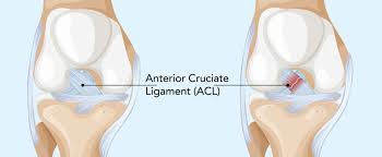 Acl ligament treatment Sagar