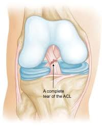 Acl ligament treatment Shahdol