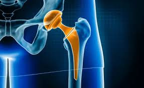 Advanced Hip Replacement In Bhandara