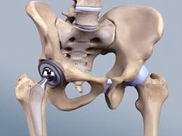 Advanced Hip Replacement In Chhindwara