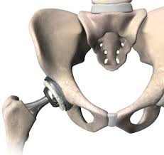 Advanced Hip Replacement In Gadchiroli
