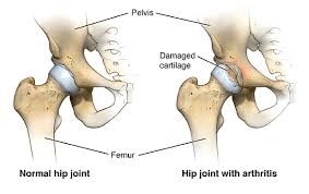Advanced Hip Replacement In Gondia