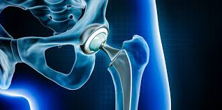 Advanced Hip Replacement In Hoshangabad