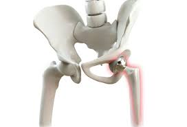 Advanced Hip Replacement In Yavatmal