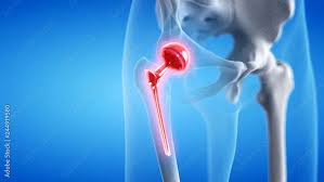 Ayushman Bharat Hip Replacement In Harda