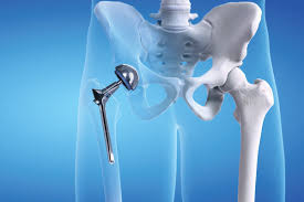 Ayushman Bharat Hip Replacement In Shahdol
