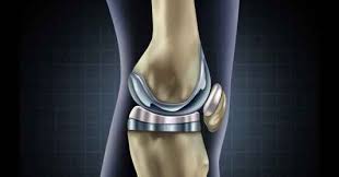 Ayushman Bharat Knee Replacement In Sagar