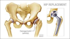CGHS Hip Replacement In Amravati