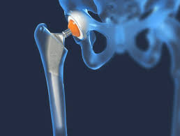 CGHS Hip Replacement In Balaghat