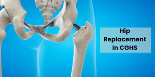 CGHS Hip Replacement In Chandrapur