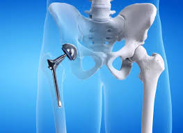 CGHS Hip Replacement In Chhindwara