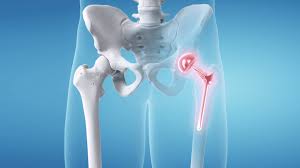 CGHS Hip Replacement In Gondia