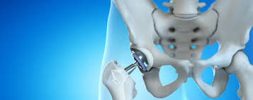CGHS Hip Replacement In Sagar