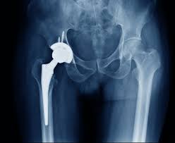Free Hip Replacement Ayushman Bharat In Amravati