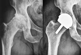 Free Hip Replacement Ayushman Bharat In Chandrapur