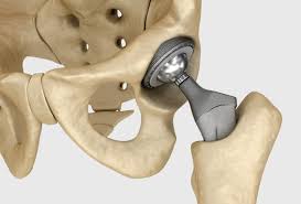 Free Hip Replacement Ayushman Bharat In Gondia