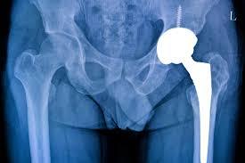 Free Hip Replacement Ayushman Bharat In Mandla