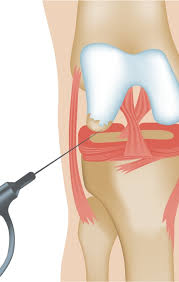 Government Approved Joint Surgery In Chandrapur