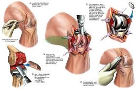 Government Approved Joint Surgery In Katni