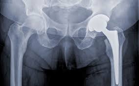 Hip Replacement Package Ayushman Bharat In Mandla