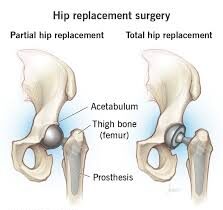 Hip Replacement Package Ayushman Bharat In Sagar