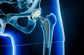 Hip Replacement in Gondia