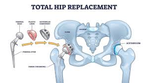 Hip Replacement in Rewa