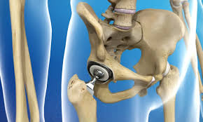 Hip Replacement in Yavatmal